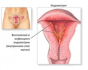 Через місяць після пологів болить поперек