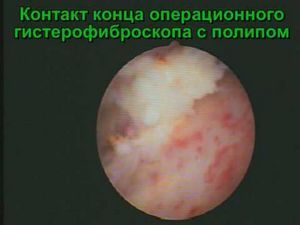 Послід після пологів фото у жінок