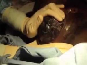 Послід після пологів фото у жінок