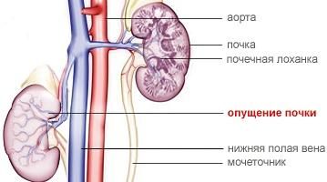 нефроптоз